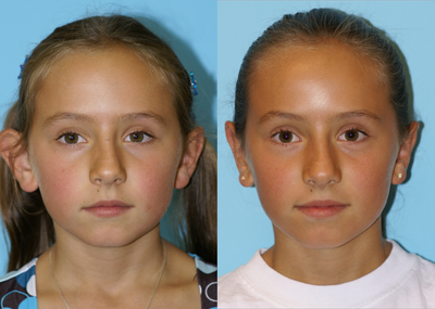 Otoplasty - This patient had ear pinning surgery (otoplasty) to both of her ears