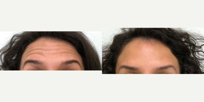 35-44 year old woman treated with Dysport, Botox - Before and After of a patient who had neurotoxin for the prevention of wrinkles to the frontalis muscle