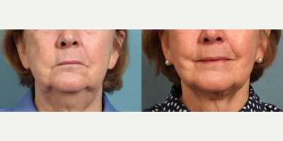 Woman treated with PrecisionTx - Woman treated with PrecisionTx with Liposuction and MyEllevate