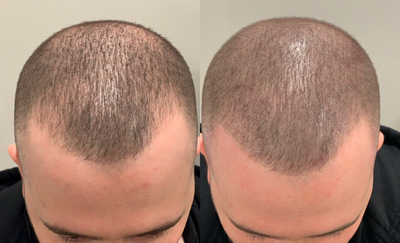 25-34 year old man treated with Scalp Micropigmentation - Before and after SMP