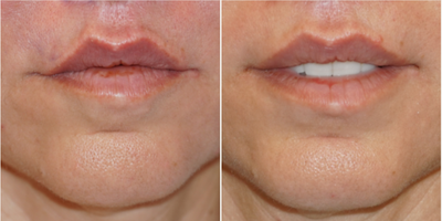 35-44 year old woman treated with Lip Repositioning - This patient came to me after she was unhappy from her previous lip lift. She was looking to have her upper teeth show slightly at rest, and she didnt like how her original lip lift did not address the lateral upper lip (this is very common). I performed a modified upper lip lift to address her concerns and give her the look she desired.