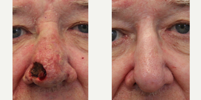 75 and up year old man treated with Dermabrasion - This is a 77 year old male who had a basal cell carcinoma of his nose.  It was resected by a Mohs surgeon and sent to be for reconstruction.  I rearranged nasal and glabellar skin to cover the defect.  In order to improve the appearance of the resulting scar and treat his preexisting rhinophyma, I performed a second stage dermabrasion procedure.