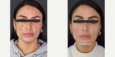 Woman treated with Skin Lightening, Skin Rejuvenation - Melasma is a condition that can be influenced by factors such as sun exposure, hormonal changes, and genetic predisposition. The treatments aim to diminish blemishes and prevent their appearance, providing a significant improvement in the skin's appearance. However, do not remove the condition permanently. Consistency in treatment and ongoing care is essential to maintaining results.