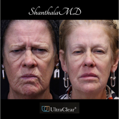 55-64 year old woman treated with CO2 Laser, Laser Resurfacing, Fractional Laser, UltraClear Laser - Life Changing Transformation with UltraClear Laser-Coring treatment at ShanthalaMD