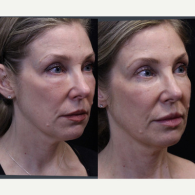 Woman treated with UltraClear Laser - Woman treated with UltraClear Laser