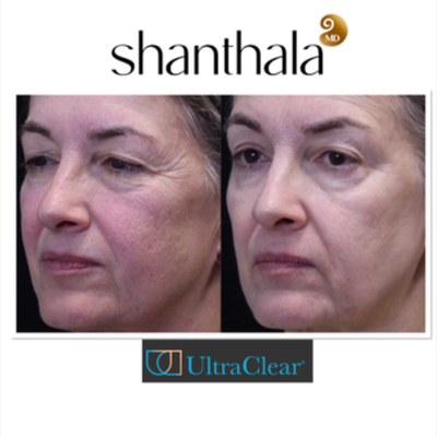Patient treated with UltraClear Laser - Patient treated with UltraClear Laser