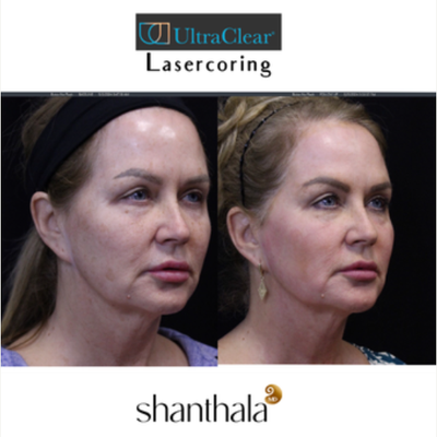 Patient treated with UltraClear Laser - Patient treated with UltraClear Laser