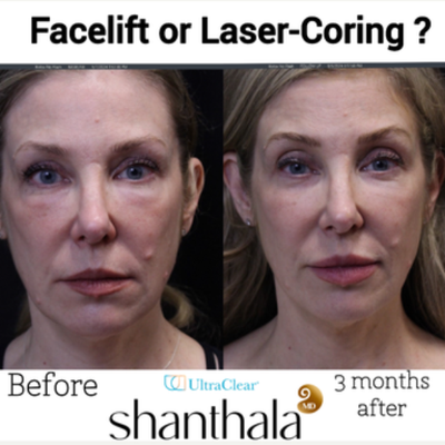 Woman treated with UltraClear Laser - Woman treated with UltraClear Laser