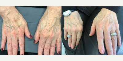 65-74 year old woman treated with Laser Peel - 74 year old woman treated with 1 treatment of Ruby Laser