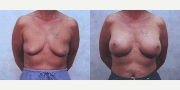 Breast Lift - Breast Lift