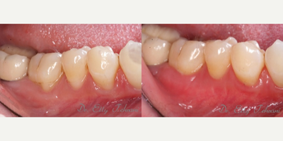 35-44 year old woman treated with Gingival Graft - Female patient with recession and sensitivity on lower right teeth.&nbsp; Alloderm grafting technique was used to cover root exposure.