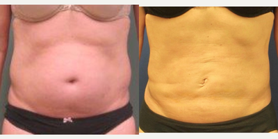 35-44 year old woman treated with SAFELipo - 35-44 year old woman seeking improvement to contour of abdomen and flanks, treated with liposuction (SAFE, power-assisted)