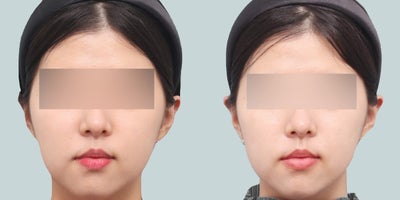18-24 year old woman treated with Skin Tightening - The patient was concerned about the right side of her face being more bigger than the left side. An examination was done and there was an increase in her skin laxity. So a HIFU energy-based device (Shrink / Shurink Universe) was performed for skin tightening. Thus, it corrected her facial asymmetry and her overall skin laxity.