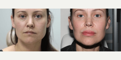 Woman treated with Silikon 1000 - Woman treated with Silikon 1000