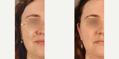 Mole Removal x 2 - 35-year-old female who presented complaining of two facial lesions. She is shown 9 months after removal of these lesions, demonstrating near-invisible scarring and no impact on normal facial movement.