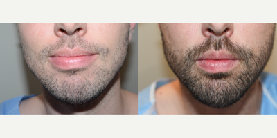25-34 year old man treated with Beard Transplant - Result of 3300 FUE grafts to the beard30 yo patient underwent two beard transplant procedures to achieve his results.