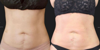 Woman treated with Cryoskin - We did 5 Cryoslimming treatments. The pic on the right was taken3 weeks after the last Cryoslimming session.