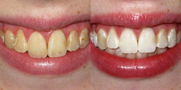 what can i eat after zoom whitening