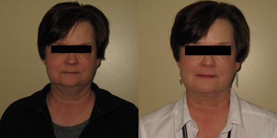 45-54 year old woman treated with FaceTite - 6 Months post op from Facetite to lower face and neck