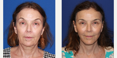 65-74 year old woman treated with Facelift - 63 yo female who was not happy with how tired she appeared. She still works and is very energetic and did not feel her appearance matched with how she felt. Here she is one year after looking refreshed and rejuvenated. She underwent a face and neck lift without general anesthesia. Her neck and jawline look amazing , well contoured. Her neck appears longer and her incisions are barely visible.