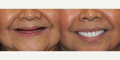 All-on-4 Dental Implants - All-on-4 Dental Implants