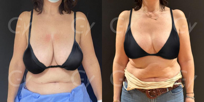 45-54 year old woman treated with Breast Reduction, Breast Lift - 45-54 year old woman treated with Breast Reduction, Breast Lift by M.D. Gray Yeiladal