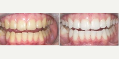 13-80  years old  treated with BriteSmile - Beautiful whitening, for almost everybody.