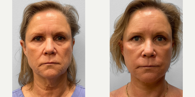 55-64 year old woman treated with Facelift, Brow Lift, Laser Resurfacing, Facial Fat Transfer - This woman in her early sixties wanted to enhance the overall appearance of her face and address fine lines, loose skin, and drooping eyelids.  She and Dr. Howell discussed her options for facial rejuvenation of which she chose to proceed with a facelift, endoscopic browlift, TFX CO2 laser resurfacing and fat injections.  Her results look natural with great symmetry and brow function. She is shown before and three months afterwards.