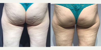 65-74 year old woman treated with Resonic - 67 year old woman treated with Resonic for cellulite. Resonic treatment of cellulite of the buttocks results after three months. More improvement may be obtained as more collagen is produced naturally in the next 3-9 months. No down time.Very comfortable treatment compared to most other treatments for cellulite.Impressive results, but realistic. Not all cellulite can improve as much and some areas are more resistant.