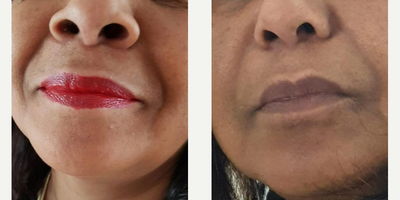 Woman treated with Rhinoplasty, Alarplasty - Alar base reduction - 7 month post-op