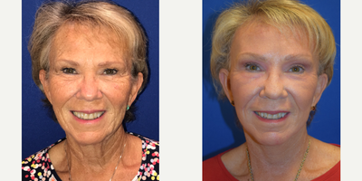 65-74 year old woman treated with Laser Resurfacing - 67 year old female who complained of facial laxity and droopy eyebrows, as well as wrinkles throughout her face. She underwent a facelift, brow lift and J-Plasma resurfacing.