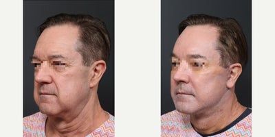 64 year old man treated with Deep Plane Face and Neck Lift, Endolift, Stem Cell Facial Fat Transfer, Submentoplasty, and Lower B - Deep Plane FaceNeck LiftEndoliftStem Cell Facial Fat TransferSubmentoplastyLower Blepharoplasty.