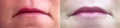 45-54 year old woman treated with Restylane Silk - Restylane Silk injected with cannula on the lips and corners of the mouth.