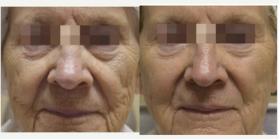 65-74 year old woman treated with multiple Fractora RF - 65-74 year old woman treated with multiple Fractora RF