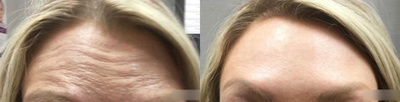 Woman treated with Botox - Woman treated with Botox