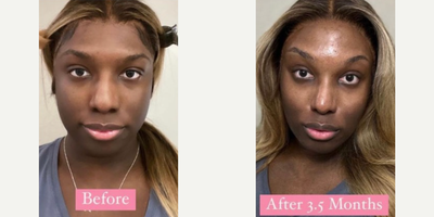 Woman treated with Facial Feminization Surgery - Woman treated with Facial Feminization Surgery, shown 3.5 months post op.