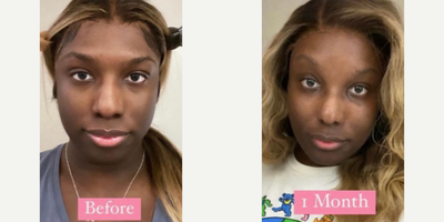 Woman treated with Facial Feminization Surgery - Woman treated with Facial Feminization Surgery, shown 1 month post op.
