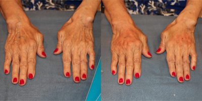 65-74 year old woman treated with Radiesse in the hands - This 72 year-old female presents with a chief complaint of an aged appearance to her hands. She subsequently had 1.5 cc of Radiesse injected into each hand. The addition of Radiesse (aka filler or volume) to the volume depleted dorsal (top) of the hands, in order to camouflage prominent veins and ligaments is an FDA approved treatment. The result will last for approximately one year. The treatment is relatively quite safe and very effective. The treatment is well-tolerated and takes approximately 15-20 minutes. There is essentially no down time.