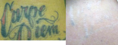 Tattoo removal  - Update:&nbsp;photo is an update after 4th treatment.