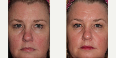 Women After Six Spectra Peels - Women after six spectra peels for red spots.