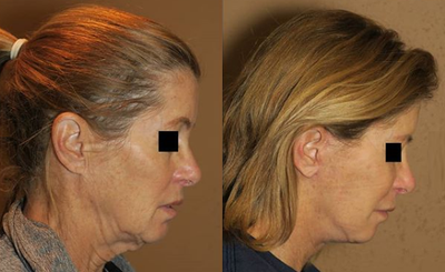 Woman treated with Cheek Lift - Woman treated with Cheek Lift