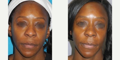 Woman treated with African American Rhinoplasty - Woman treated with African American Rhinoplasty