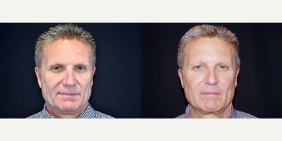 55-64 year old man treated with Bellafill - 56 year old male received 1 syringe of Bellafill to his nasolabial folds; photos depict the patients results 6 months post-treatment.