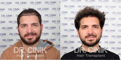 25-34 year old man treated with FUE Hair Transplant - 33 Years Old Male Patient - Norwood III  - 4150 Grafts