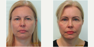 60 year old woman treated with Facelift - This woman presented with overall concerns of facial aging. Although very active and still working, she stated that she started looking like her mother with tired heavy eyelids, jowls, and neck fullness. She presented with the desire to address all of these concerns in one treatment session. We decided to perform a lower facelift, necklift, and upper blepharoplasty in order to improve her areas of concern. Under oral sedation with valium (no IV needed), we performed all procedures under local anesthesia in our office. Procedure time was slightly less than three hours. Her results demonstrate significant, and natural, improvement in her upper eyelid show, along with marked decrease in the overall heaviness of her neck and jawline.