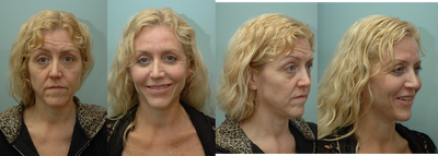 Facial Reconstructive Surgery - 
	Facial Reconstructive Surgery