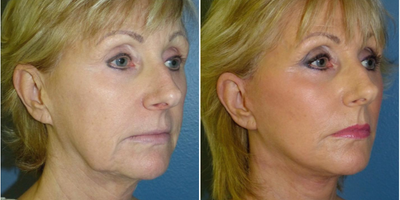 69 year old woman treated with Laser Resurfacing - 69 year old woman treated with SMAS Facelift as well as Neck Lift, Facial Fat Transfer, and CO2 Laser Resurfacing to treat laxity, volume depletion, and improved texture, shown 3 years post op.