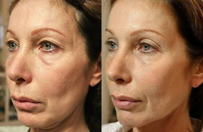 45-54 year old woman treated with Thermage - 3 months after Thermage treatment