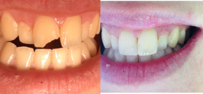 25-34 year old woman treated with Tooth Repair - Fractured Front Tooth