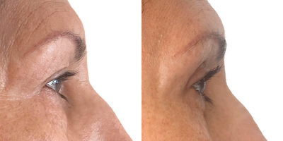 55-64 year old woman treated with Eyelid Surgery, Brow Lift - In this case we did a complete rejuvenation of the eyes blefaroplasty and brow lift. In the upper eyelids the scar is usually in the middle area of the mobile eyelid, which is the crease when we open the eye. In the lower eyelid, the scar on the edge of the eyelashes is called transpapellar. The scar in the brow lift it's totally hidden in the hairline. In my opinion, it has to be a surgery with a very precise indication because when you make the cut below, the ligament that holds the eye. It is a ligament that has a certain capacity to resist tension. As we reduce the amount of skin in the lower eyelid area, the expression may change.